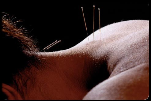 acupuncture fibromialgia
