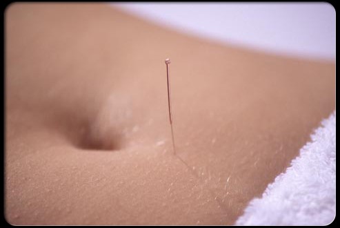 acupuncture-menstruación