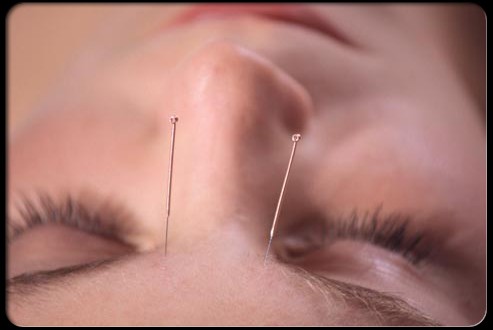 acupuncture migrañas